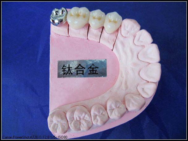 钛合金烤瓷牙-义齿|义齿加工|义齿修复|义齿视频-全瓷