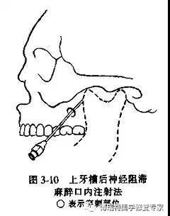 新闻中心 -> 新闻浏览 上牙槽后神经阻滞麻醉   适用症:上颌骨后部